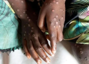 MPOX
